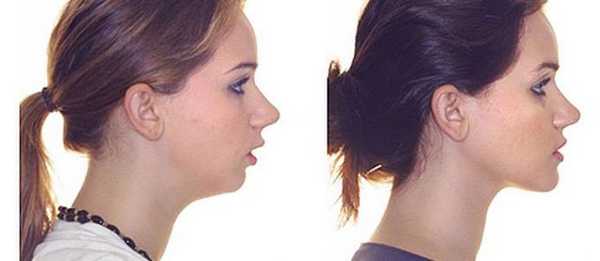 глубокий прикус у взрослых