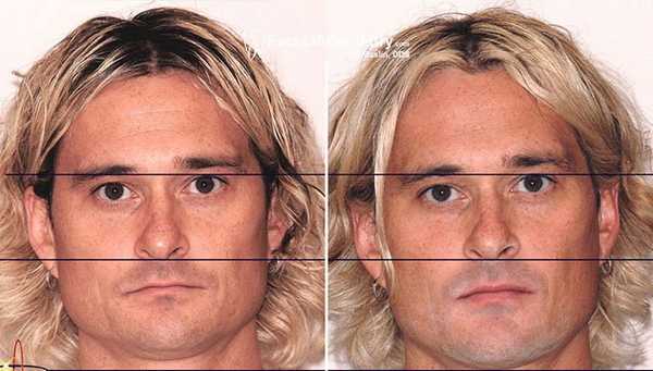 глубокий прикус лечение