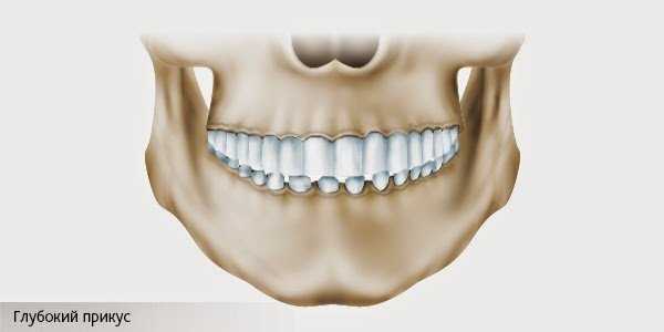 глубокий прикус