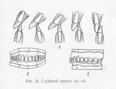 Уровень контакта режущей поверхности и бугорков с обозначением травмирования альвеолярного отростка в фас и профиль.