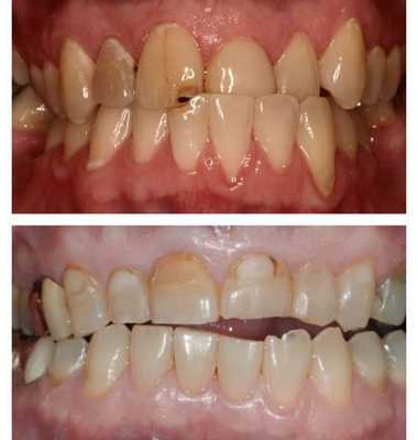 Повреждение твёрдых тканей зубов