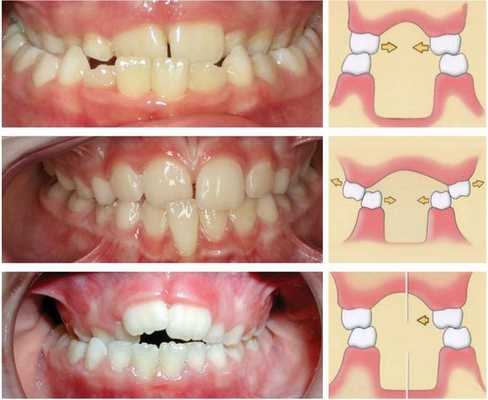 Типы перекрёстного прикуса