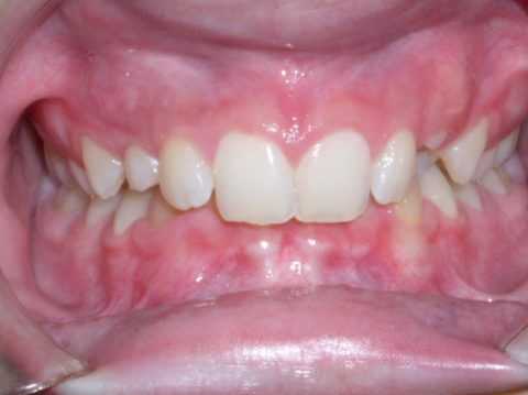 Полное закрытие резцами нижних зубов переднем отделе челюсти.