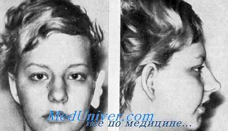 глухота с мигрогнатией и вислоухостью