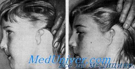 глухота с расщеплением лица