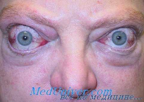 преднизолон в эндокринной офтальмопатии