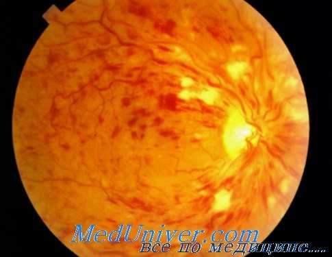 окклюзия вен сетчатки