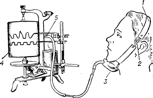 Рис. 3. Схематическое изображение графической регистрации жевательных движений нижней челюсти с помощью мастикациографа (по Рубинову): 1 — фиксирующая повязка; 2 — резиновая перемычка; 3 — футляр с резиновым баллончиком; 4 — кимограф для записи жевательных движений; 5 — капсюла Марея.