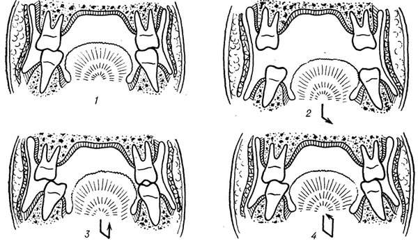 Рис. 2. Схематическое изображение цикличности жевательных движений (по Гизи): 1 — исходное положение — зубы сомкнуты, челюсти находятся в положении центральной окклюзии; 2 — зубы разомкнуты, нижняя челюсть опущена и смещена в сторону; 3 — зубы начинают смыкаться, нижняя челюсть поднимается вверх и устанавливается в положении боковой окклюзии; 4 — челюсть сместилась горизонтально в положение центральной окклюзии (исходное положение). Стрелками указано направление движения нижней челюсти.