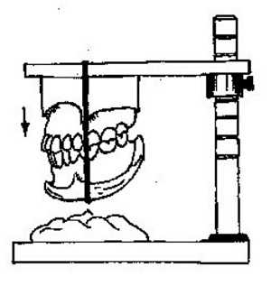 Оклюдатор Симона