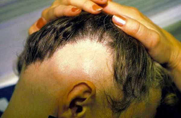 Субтотальная форма