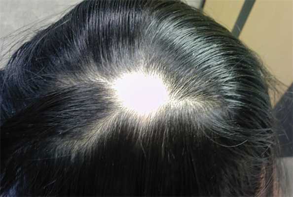 Очаговая алопеция у детей может разрастись при отсутствии лечения