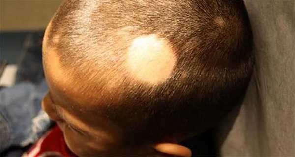 гнездовая алопеция у детей при отсутствии лечения
