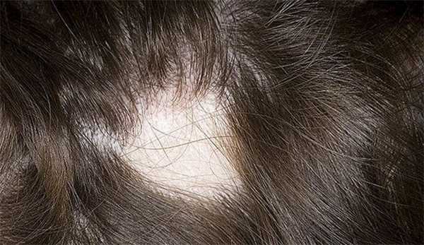 ochagovaya-alopetsiya-y-detei-640x427