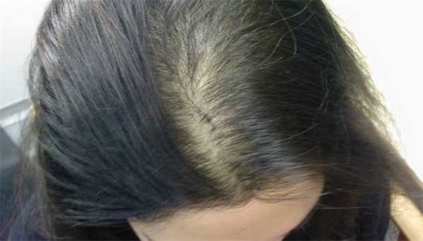 Первые причины гнездовой алопеции у детей - поредение волос на участке, напоминающем гнездо