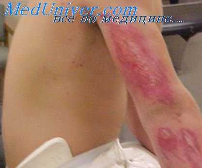 ссадины на теле