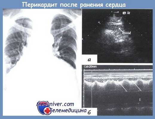 перикардит после ранения сердца
