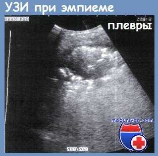 УЗИ при эмпиеме плевры