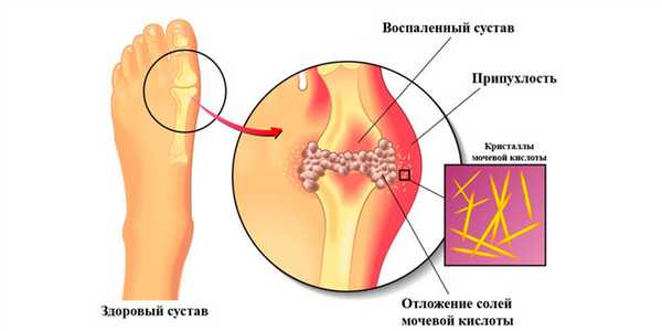 Острый подагрический артрит
