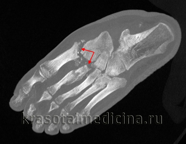 Гнойный артрит