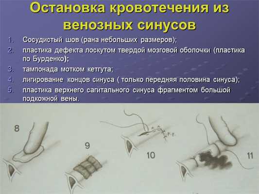 Остановка кровотечения из венозных синусов Сосудистый шов (рана небольших раз. 