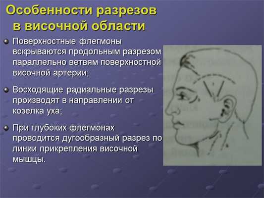 Особенности разрезов в височной области Поверхностные флегмоны вскрыва. 