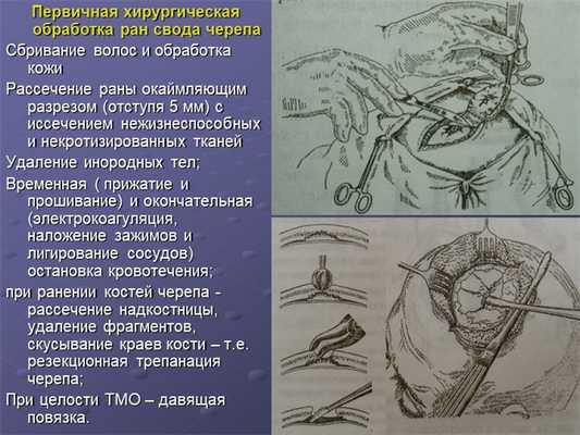 Первичная хирургическая обработка ран свода черепа Сбривание волос и обработк. 