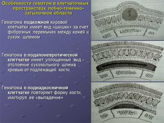 Особенности гематом в клетчаточных пространствах лобно-теменно-затылочной обл. 