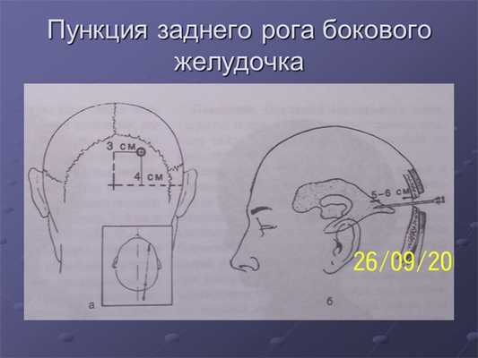 Пункция заднего рога бокового желудочка