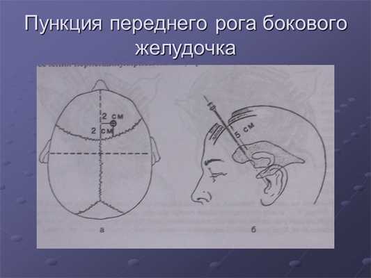 Пункция переднего рога бокового желудочка