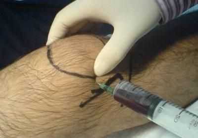 Пункция сустава