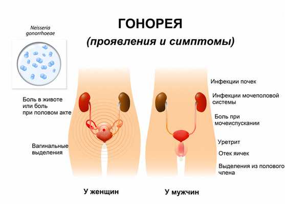 Симптомы гонореи.jpg