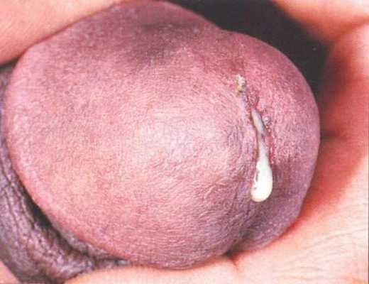 нойные выделения из мочеиспускательного канала или половых путей при гонорее