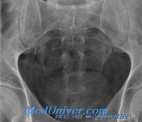 горизонтальный перелом крестца