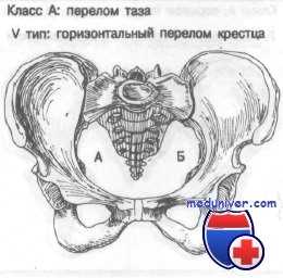 горизонтальный перелом крестца