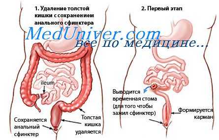 язвенный колит