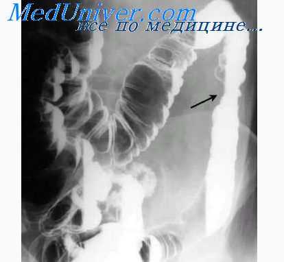 язвенный колит