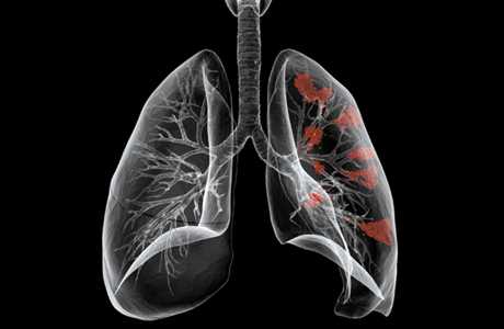 Грибковая пневмония