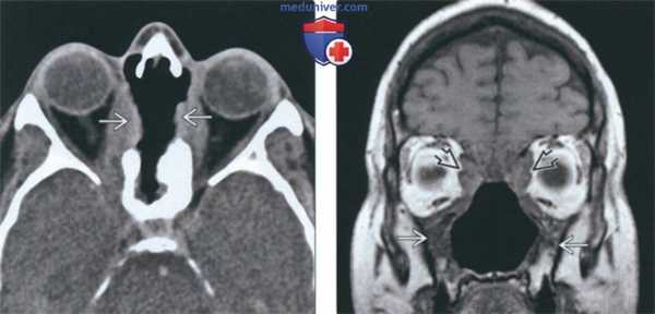 КТ, МРТ при синоназальном гранулематозе с полиангиитом (гранулематозе Вегенера)