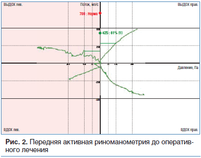 Рис. 2. Передняя активная риноманометрия до оперативного лечения