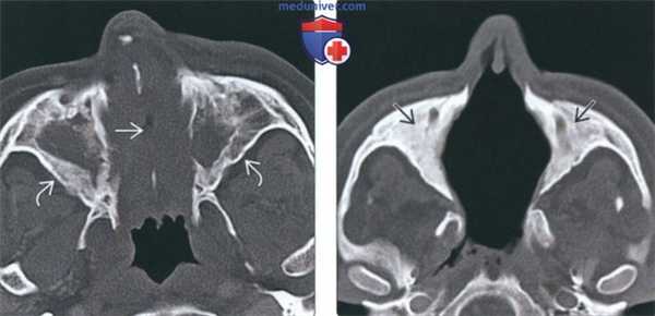 КТ, МРТ при синоназальном гранулематозе с полиангиитом (гранулематозе Вегенера)