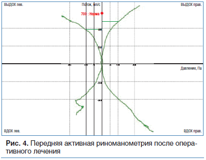 Рис. 4. Передняя активная риноманометрия после оперативного лечения