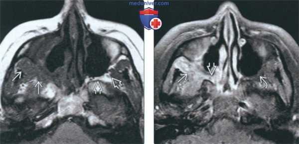 КТ, МРТ при синоназальном гранулематозе с полиангиитом (гранулематозе Вегенера)