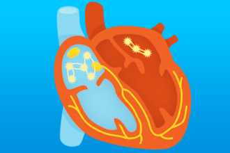 Причины возникновения мерцательной аритмии