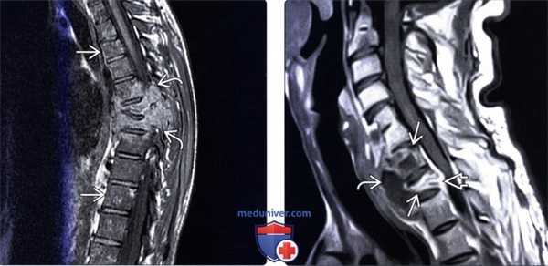 МРТ при грибковом спондилите