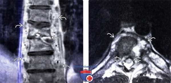 МРТ при грибковом спондилите