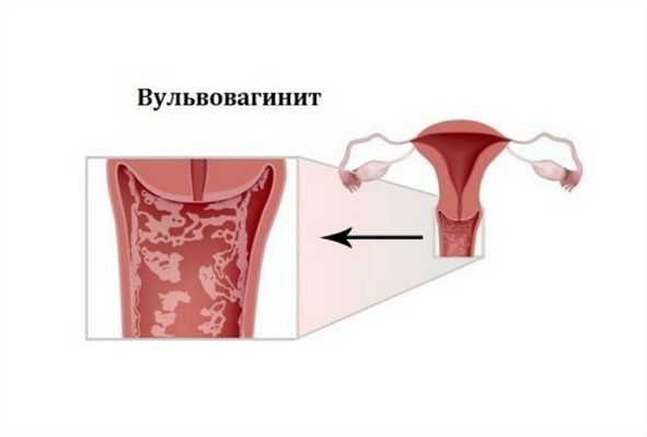 Вульвовагинит