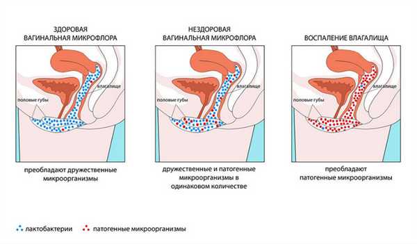 Влияние антибиотиков на микрофлору влагалища