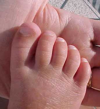 Фото Грибок ногтей у детей