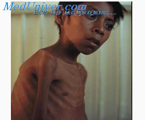 вирусные пневмонии